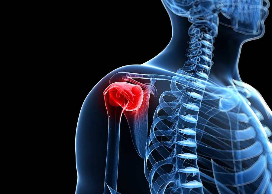 Rotator Cuff Tear