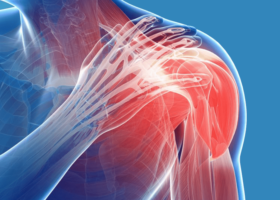 Shoulder Dislocation