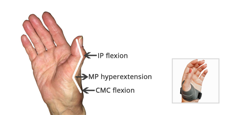 Thumb Pain – 1st CMC Arthritis