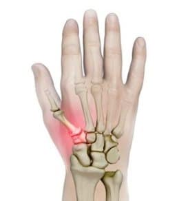Thumb Pain – 1st CMC Arthritis